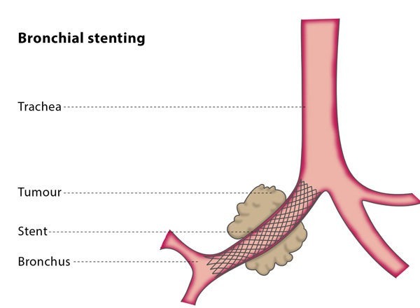 Airway stent insertion (Bronchial Stent)
