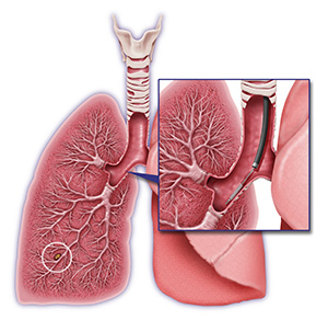 Biopsy of lung or lymph node